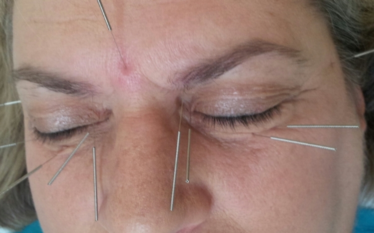 Acupuncture around the eye